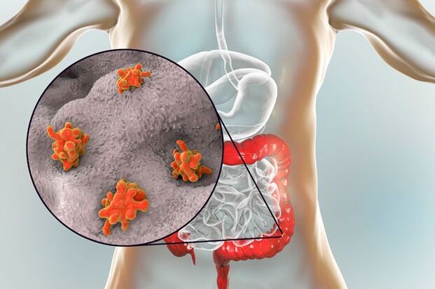 parazitų tipai žmogaus kūne
